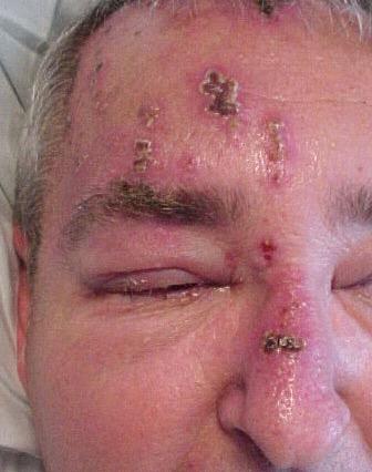 Herpes Zoster Ophthalmicus Oral antiviral Rx if started within 48hrs onset of rash by GP Not always eye