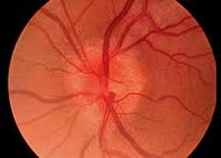 Optic Neuritis, Papilloedema