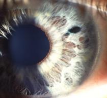 Acute Angle Closure Glaucoma Typically