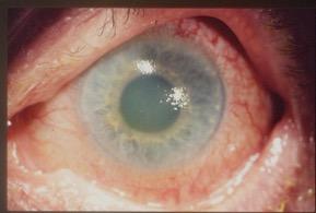 pupil High pressure, corneal oedema Closed