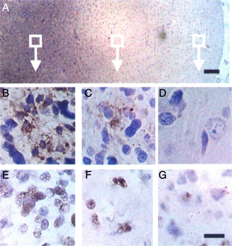 HCMV and Cancer - Glioblastoma Tumor Invasive Normal Cobbs et al, 2002 HCMV proteins and DNA detected in malignant gliomas Dziurzynski et al.