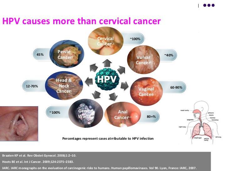 cervical cancer now a days relate to HPV and once there is a virus in the cervical area it s going to spread to all adjacent structures.