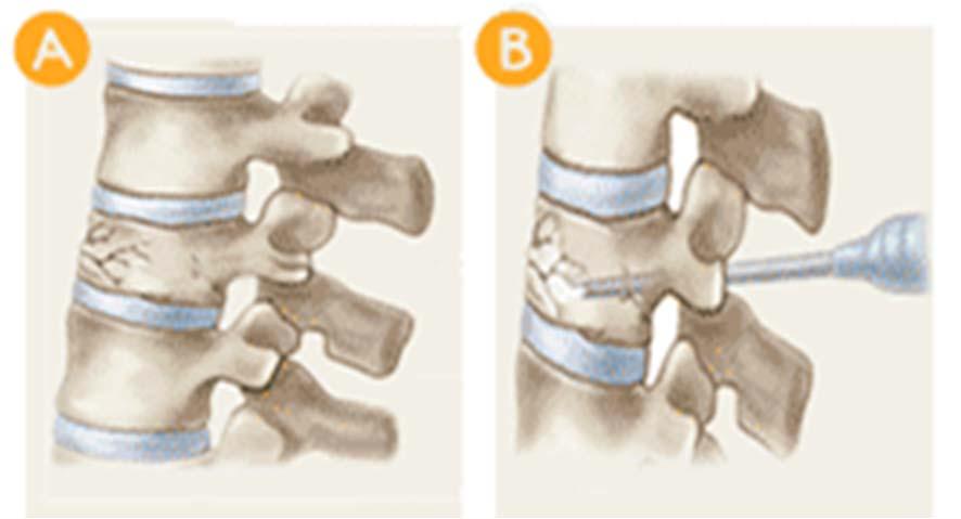 Vertebroplasty & Kyphoplasty NOT indicated for spinal cord compression Vertebroplasty Needle