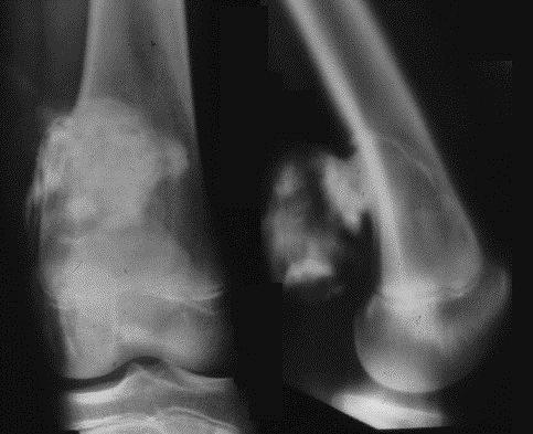 HIGH (G2) Classic osteosarcoma Primary