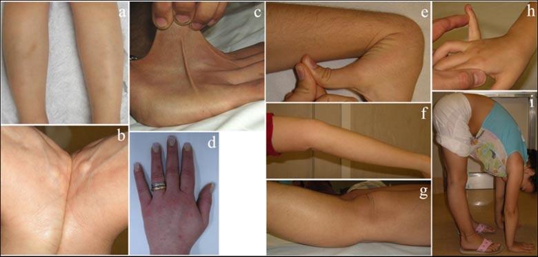 560 AMERICAN JOURNAL OF MEDICAL GENETICS PART A FIG. 1. Main manifestations of Ehlers Danlos syndrome hypermobility type.
