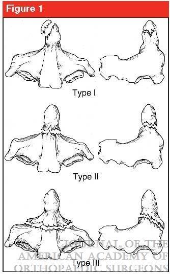 Anderson and D Alonzo / Grauer Classification Odontoid