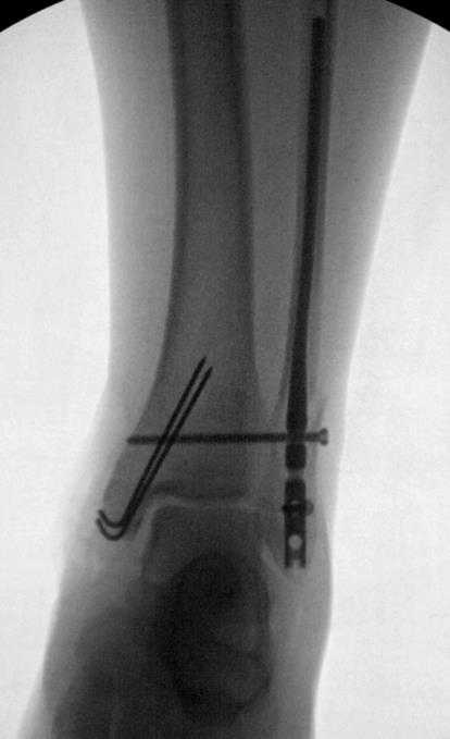 Methods Retrospective review - High risk patients with fibular IMN - January 2011 and June 2015 All surgeries were at the same