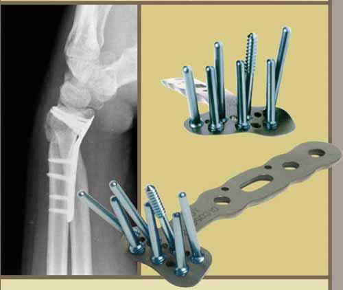 Figure 1: DVR Locking plate by Hand Innovations; threaded screw holes and drill guides facilitate anatomic positioning. (X-ray shows lateral view of fractured radius.