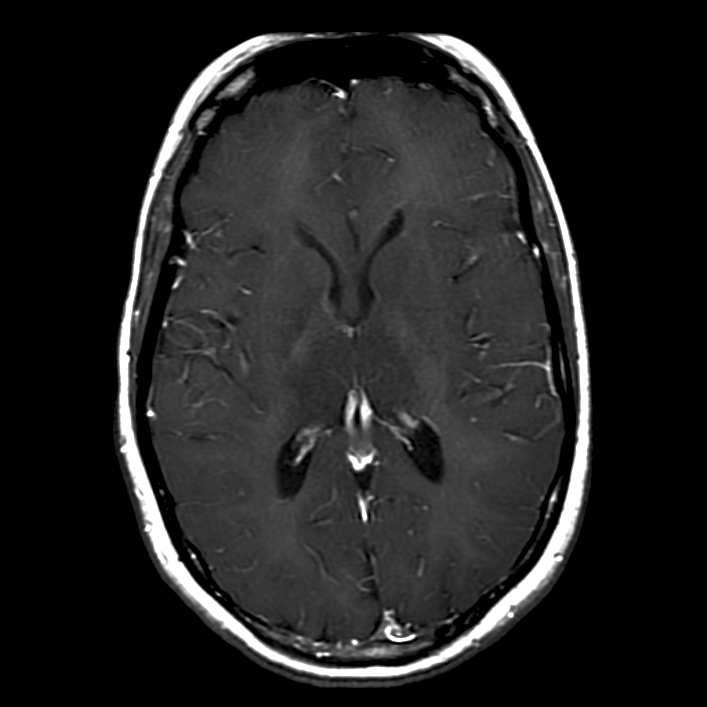 Discussion Differential Diagnosis of Diffuse White Matter Disease Metabolic disorder