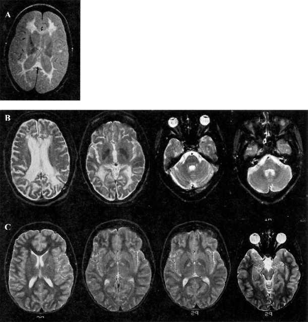Metachromatic leukodystrophy in adults: behavioral change; neuropathy; posturing; late tetraparesis