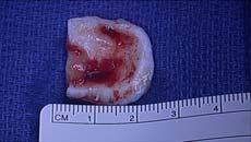 Osteochondral Fracture and Repair Acute Injuries : Osteochondral Fracture and