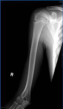 Repetitive Microtrauma Torque, Breaking Pitches Little Leaguer's Shoulder Little Leaguer's Shoulder Pain with throwing, velocity and control loss Pain to palpation over