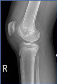 Schlatter Calcaneus / Sever s Pain over a growth center or tendon insertion Pain