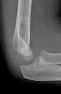 Acute Injuries: Elbow Injuries Acute Injuries: Elbow Injuries Monitor Near