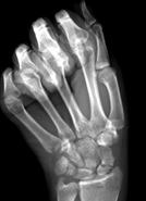 Scaphoid Fractures Uncommon, but often hard to visualize Acute Injuries: Wrist