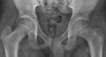 Acute Injuries: Hip / Pelvis Injuries Xrays AP and lateral of the hip SCFE
