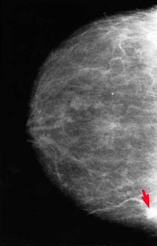 Figure 3. Breast with curvilinear structure and cancer tissue [6] At the time of mammography activities, tissues forming curvilinear structure give the same reaction with tissue suspect cancer.