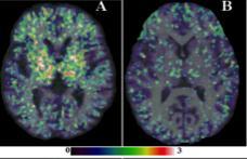 Imaging microglial activation in vivo PK11195 can be radiolabeled with 11 C and used as a tracer with PET imaging to identify and quantify microglial activation 1 [A]