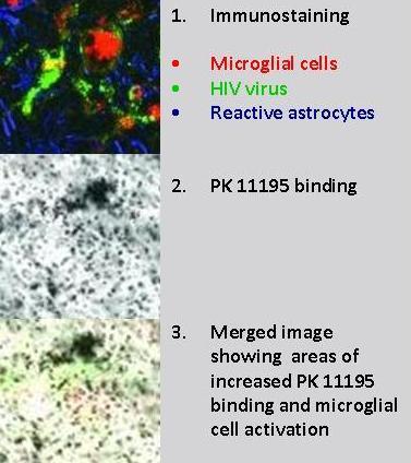 Imaging microglial activation Study population SIV-encephalitis 1 Observation with PK 11195 and PET Increased binding HIV-associated dementia 1,2 SIV without encephalitis 1 No increase HIV with mild