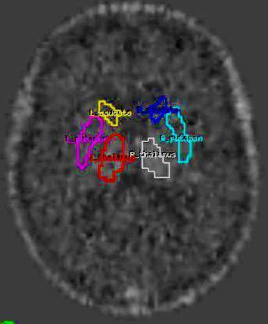 occipital, caudate, putamen, thalamus Subtle areas of increased binding maybe missed Whole brain analysis