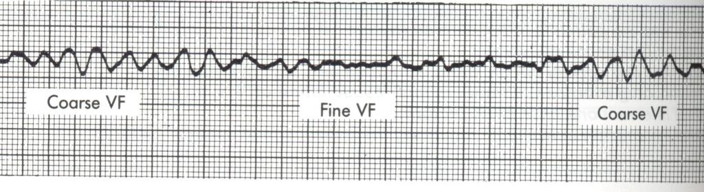 Ventricular Fibrillation & Pulseless Ventricular Tachycardia Primary Assessment Airway (basic) - Breathing - Circulation (CPR) Defibrillate (immediately) 2J/kg or equivalent Biphasic energy.