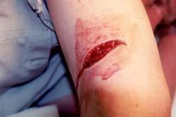 wounds and fractures (such as lacerations and closed forearm fracture) 3) Minor