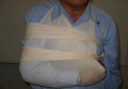 Open Arm Sling with 2 broad bandages, 1 below the injured