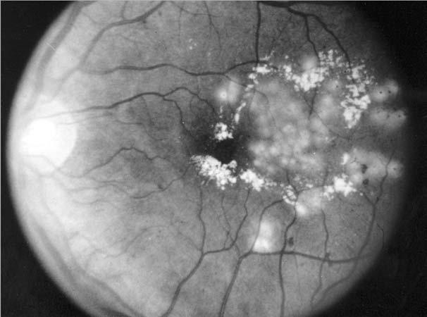 treatment Laser burns The retina