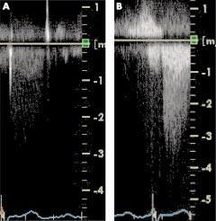 Figure 1 Spectral Doppler enhancement. (A) Spectral Doppler of flow across the aortic valve in a patient with suboptimal imaging from the apical window resulting in poor quality Doppler envelope.