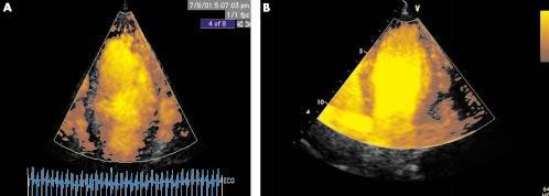 346 * Figure 3 Myocardial contrast echocardiography utilising intermittent power Doppler imaging triggered at end systole, after injection of a 0.5 ml bolus of Optison. Apical 4 chamber views.