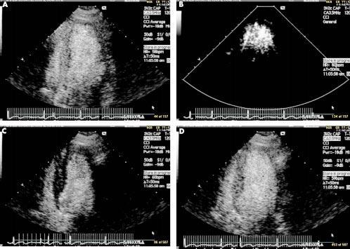 Figure 4 Real time myocardial contrast echocardiography using pulse inversion and slow intravenous injection of 0.5 ml of Optison.