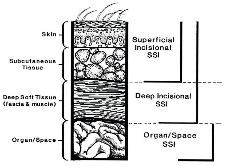DEPTH OF SSIs Epidermis Subcutaneous Tissue Superficial Incisional SSI Deep Soft Tissue (fascia & muscle) Deep Incisional SSI Organ/Space Organ/Space SSI Most surgical wound infections are limited to
