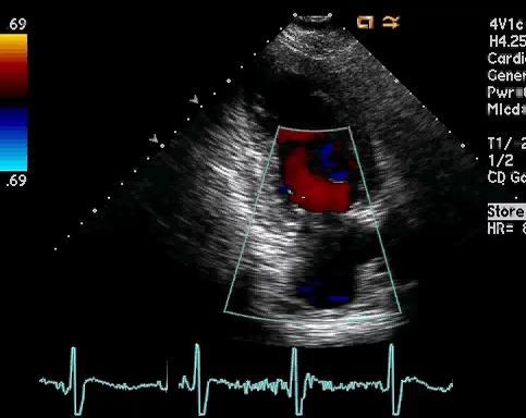 Functional MR Chronic Ischemic 50-y/o woman with murmur