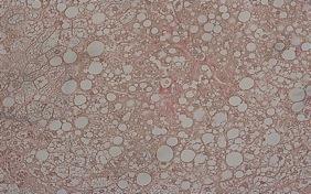 collagenstaining in the liver tissue Digitized NAFLD