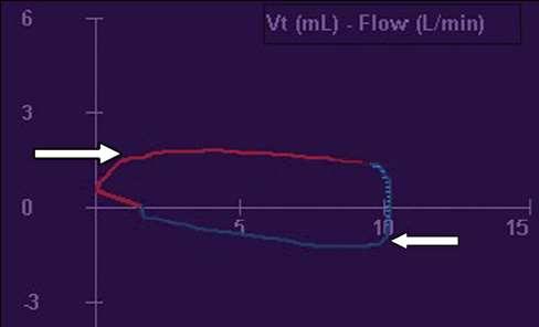 Flow volume loop The effect of altering