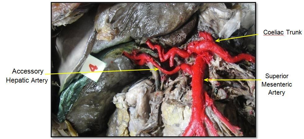 Fig. : Origin of accessory hepatic artery from superior mesenteric artery Fig.