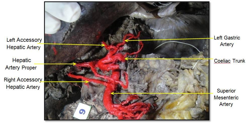 4: Gastrosplenic and hepatic trunks. Fig. 5: Duplicate right renal arteries (white arrows). Fig. 6: Duplicate left renal arteries (white arrows).
