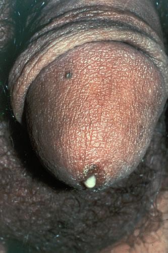 Gonococcal Urethritis: Purulent Discharge Clinical Manifestations Source: Seattle STD/HIV