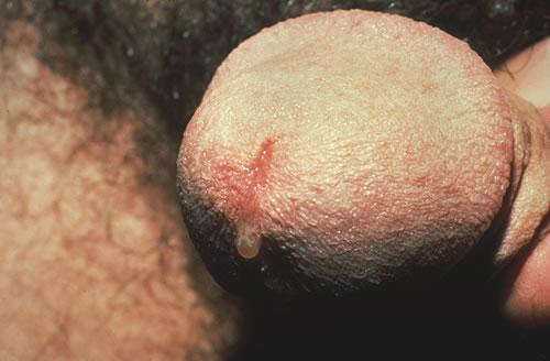 Non-Gonococcal Urethritis: Mucoid Discharge Clinical Manifestations Source: Seattle