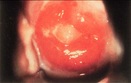 Clinical Manifestations Chlamydial Cervicitis Source: STD/HIV Prevention