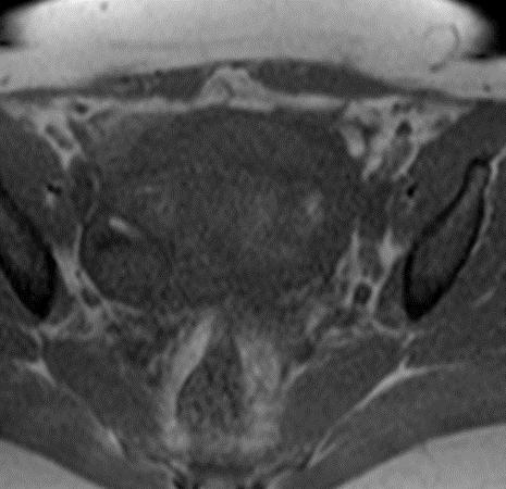 Deep Pelvic Endometriosis Fig 3A Fig 3B Fig 3C Figure 3: