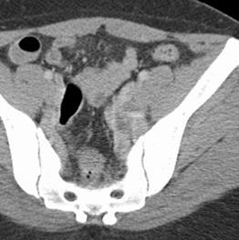 Deep Pelvic Endometriosis Fig 4 A Fig 4 B Fig 4 C Figure 4: (A)