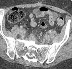 Deep Pelvic Endometriosis Fig 5 A Fig 5 B Fig 5 C Figure 5: Axial (A)