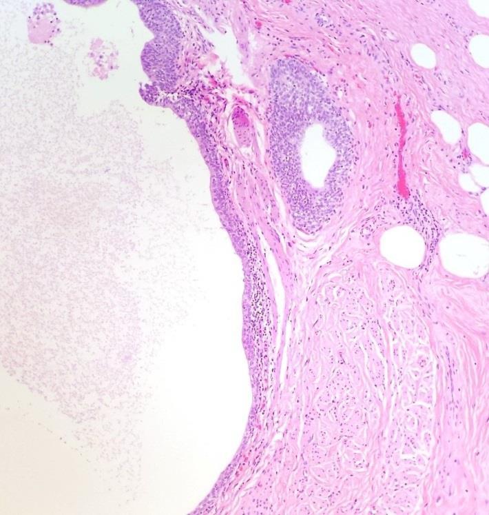 Although endometrial type stroma and hemosiderin pigmentation is not