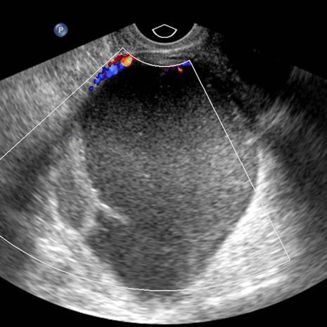 ultrasound showing cystic lesion with