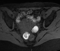 Endometrioma Fig 9 A Fig 9 B Figure 9: (A) Axial T1W Fat