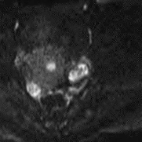 Shading ; hemorrhagic cysts are brighter on T2-weighted