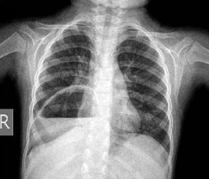 Baskin Embleton et al., Congenital hiatus hernia: A case series A B A B Figure 1. (A) A-P chest X-ray of patient 4 showing a slightly median air fluid level on the right hemithorax.