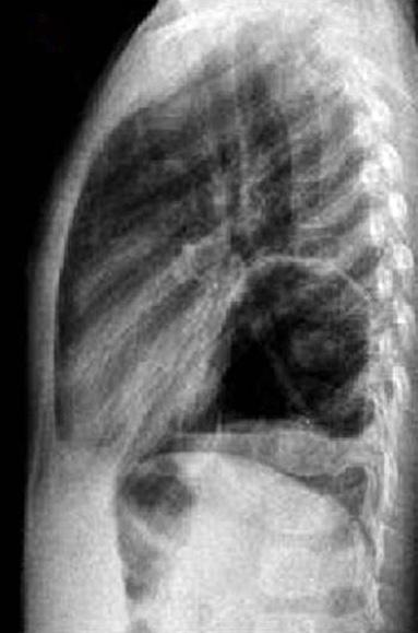 (A) A-P chest X-ray of patient 1 showing mid-thoracic air loculations resembling intestinal gas. The lesion looks like a Morgagni hernia. Gastric air is not seen at its usual location.