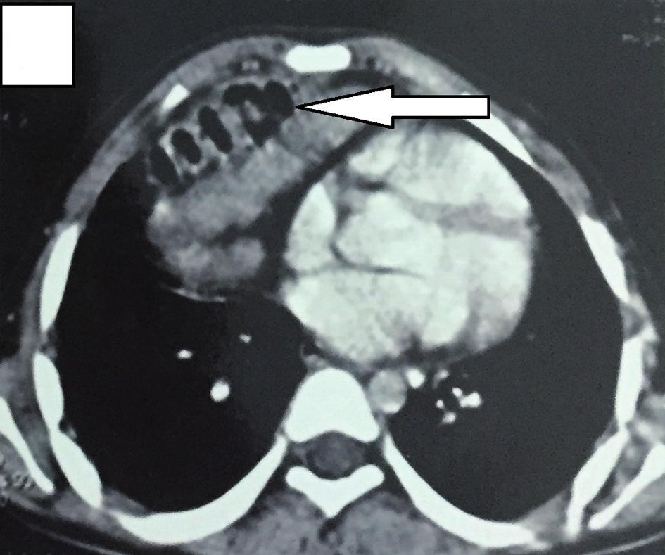 Computed tomography (CT) (chest)